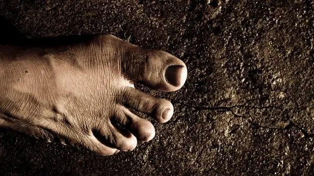 Причины, симптомы и лечение подошвенного фасциита