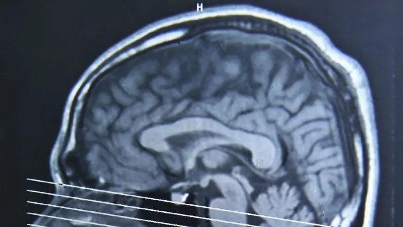Упражнения могут помочь в восстановлении после сотрясения мозга