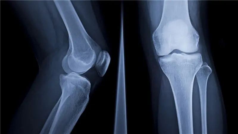 Следует ли мужчинам беспокоиться о потере костной массы?