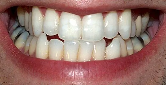 Выпечка соды делает хороший дешевый отбеливатель зубов