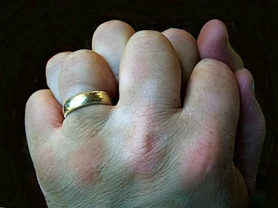 Растрескивание суставов не вызывает артрита