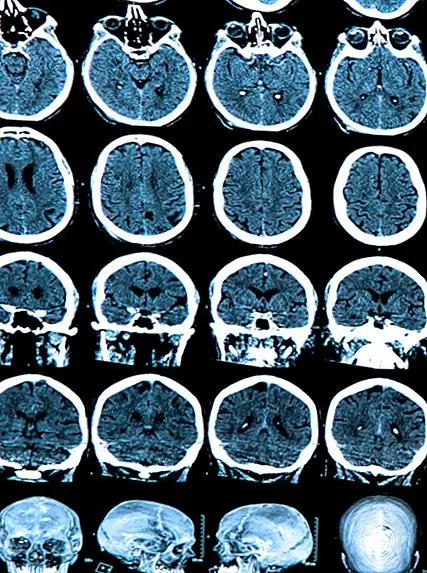 Эльси Никс и Акинетический мутизм