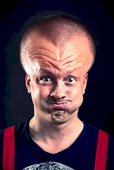 Взрывной синдром головы