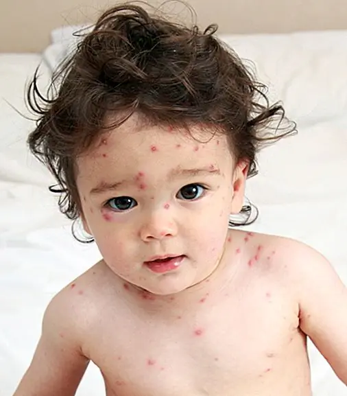 Как ветрянка получила свое название