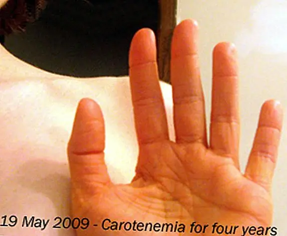 Если вы едите чрезмерное количество моркови, ваша кожа превратит оранжевую или желтую тень