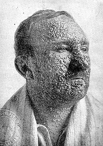 Искоренение оспы