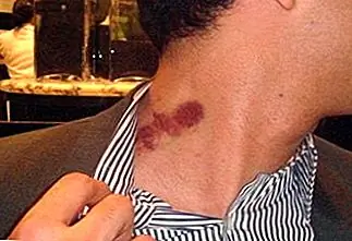 Что вызывает Хики