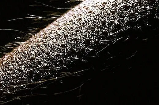 Почему люди получают гусиные суставы