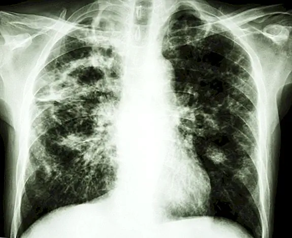 Почему туберкулез был назван «Потреблением»